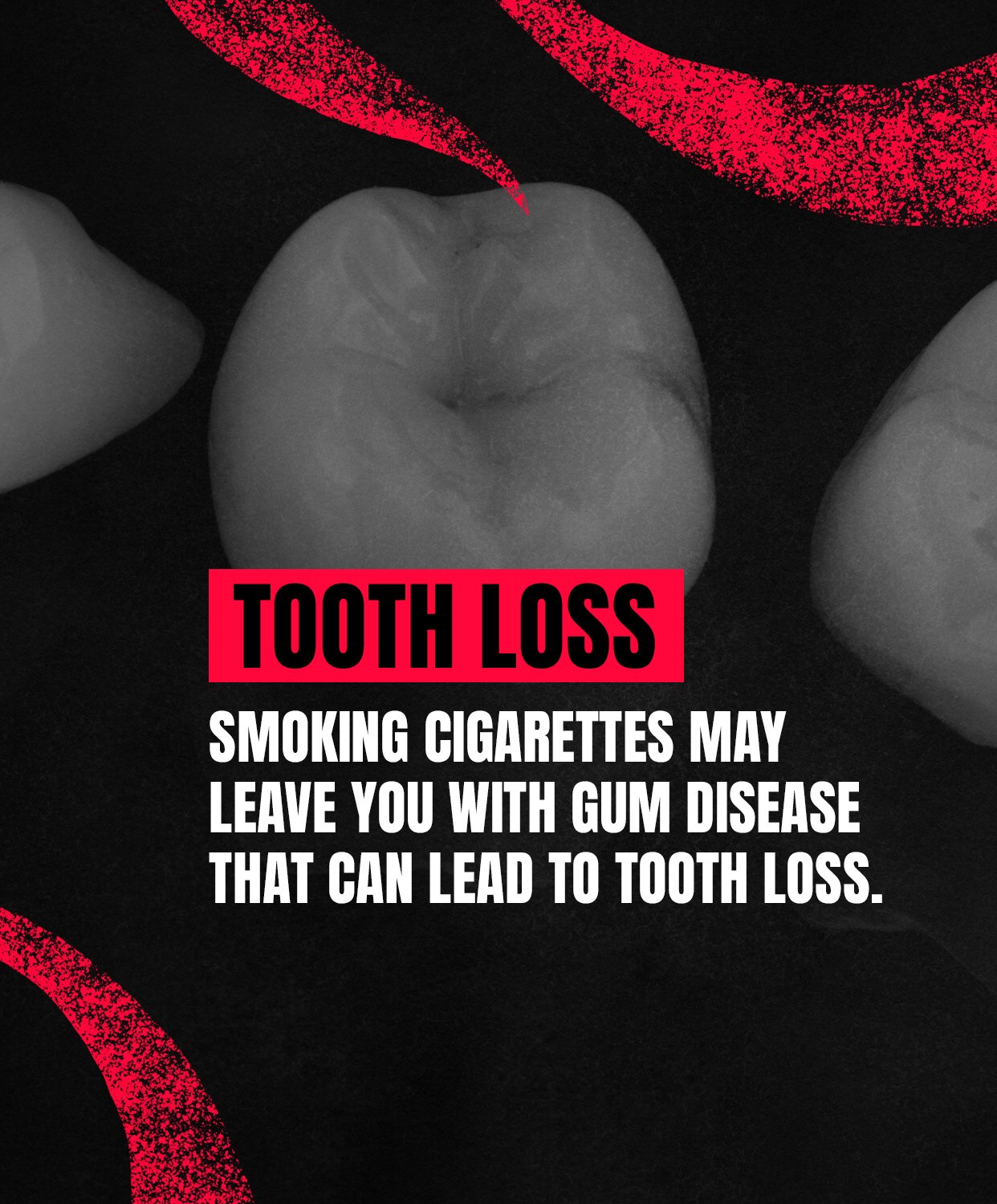 TOOTH LOSS: Smoking cigarettes may leave you with gum disease that can lead to tooth loss.