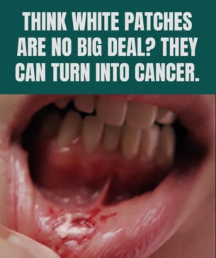 Think white patches are no big deal? they can turn into cancer